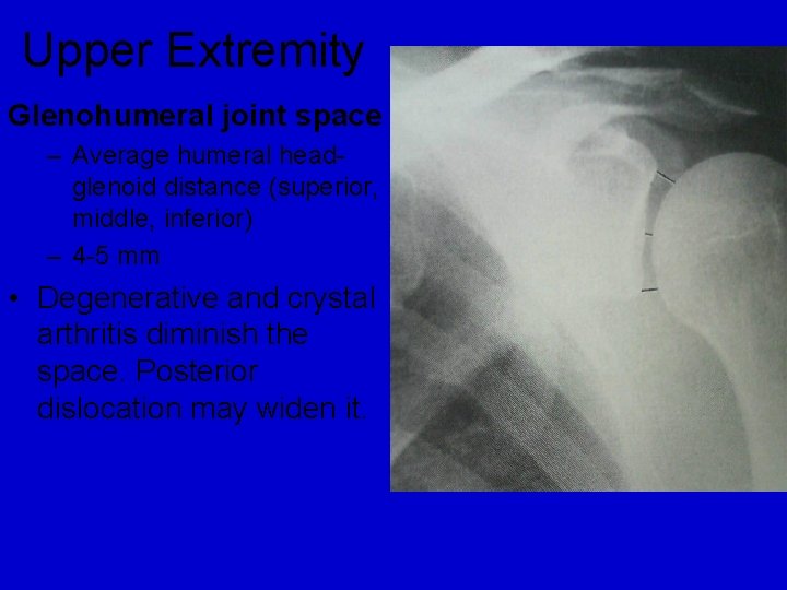 Upper Extremity Glenohumeral joint space – Average humeral headglenoid distance (superior, middle, inferior) –