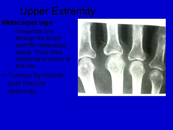 Upper Extremity Metacarpal sign – Tangential line through the fourth and fifth metacarpal heads. Upper Extremity Metacarpal sign – Tangential line through the fourth and fifth metacarpal heads.
