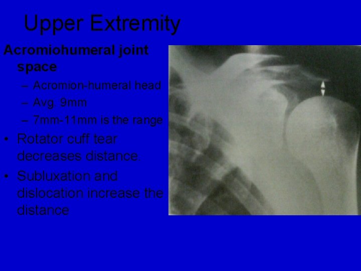 Upper Extremity Acromiohumeral joint space – Acromion-humeral head – Avg. 9 mm – 7