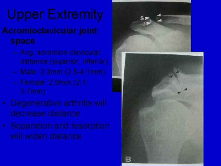 Upper Extremity Acromioclavicular joint space – Avg. acromion-clavicular distance (superior, inferior) – Male: 3.