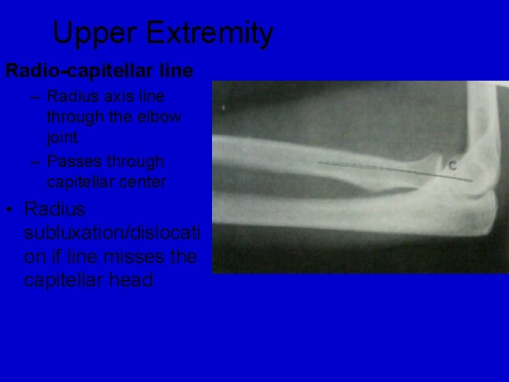 Upper Extremity Radio-capitellar line – Radius axis line through the elbow joint – Passes