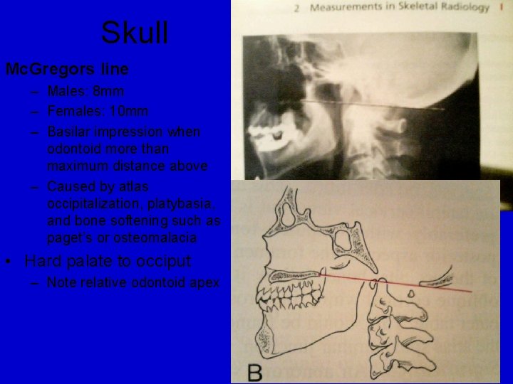 Skull Mc. Gregors line – Males: 8 mm – Females: 10 mm – Basilar Skull Mc. Gregors line – Males: 8 mm – Females: 10 mm – Basilar