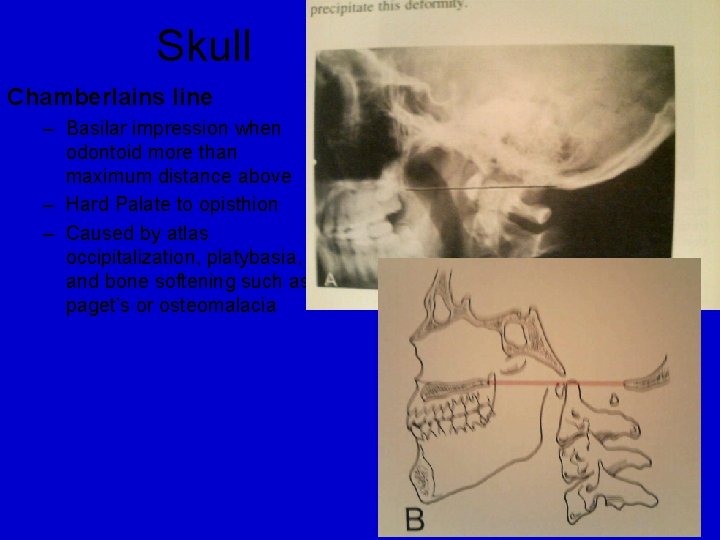 Skull Chamberlains line – Basilar impression when odontoid more than maximum distance above –