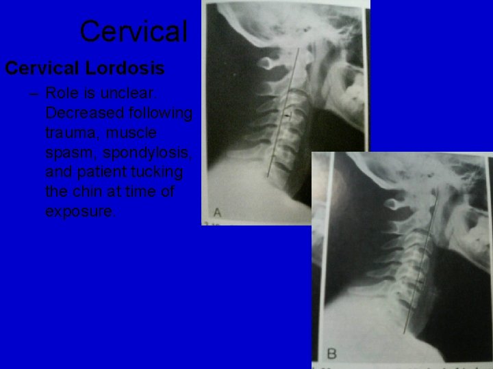 Cervical Lordosis – Role is unclear. Decreased following trauma, muscle spasm, spondylosis, and patient