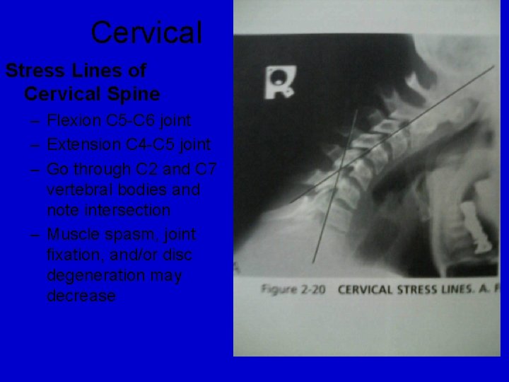 Cervical Stress Lines of Cervical Spine – Flexion C 5 -C 6 joint –