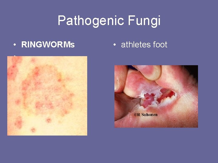 Pathogenic Fungi • RINGWORMs • • athletes foot 