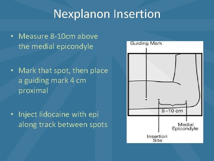 Nexplanon Insertion • Measure 8 -10 cm above the medial epicondyle • Mark that Nexplanon Insertion • Measure 8 -10 cm above the medial epicondyle • Mark that