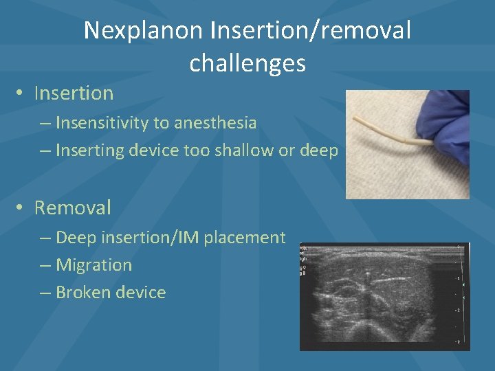 Nexplanon Insertion/removal challenges • Insertion – Insensitivity to anesthesia – Inserting device too shallow Nexplanon Insertion/removal challenges • Insertion – Insensitivity to anesthesia – Inserting device too shallow