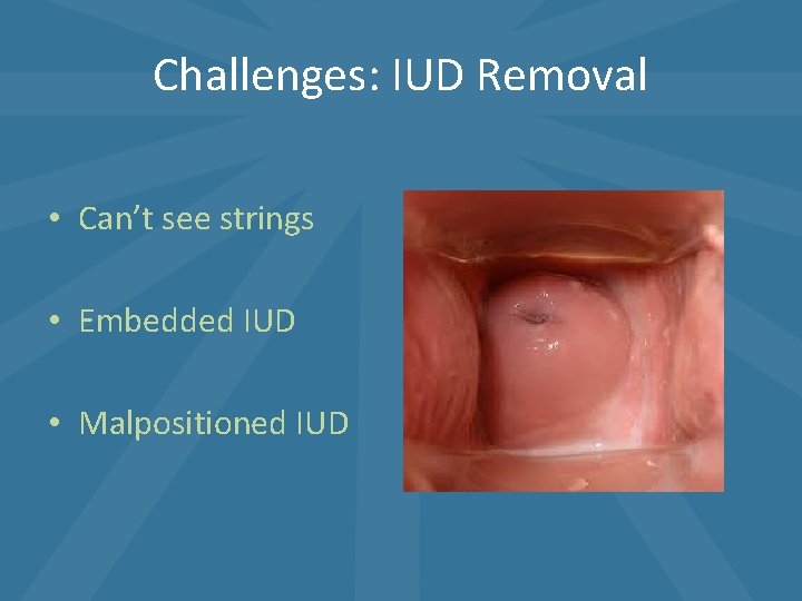 Challenges: IUD Removal • Can’t see strings • Embedded IUD • Malpositioned IUD Challenges: IUD Removal • Can’t see strings • Embedded IUD • Malpositioned IUD