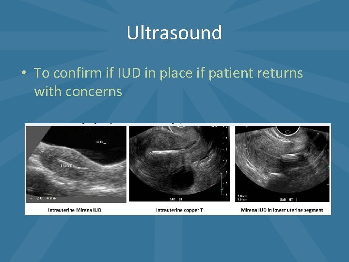 Ultrasound • To confirm if IUD in place if patient returns with concerns Ultrasound • To confirm if IUD in place if patient returns with concerns