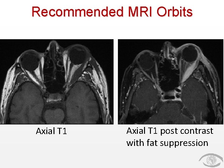 Recommended MRI Orbits Axial T 1 post contrast with fat suppression 