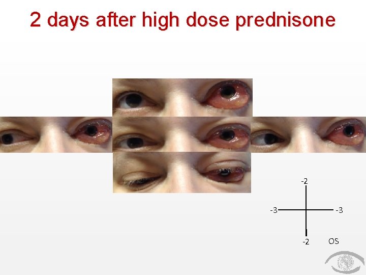 2 days after high dose prednisone -2 -3 -3 -2 OS 