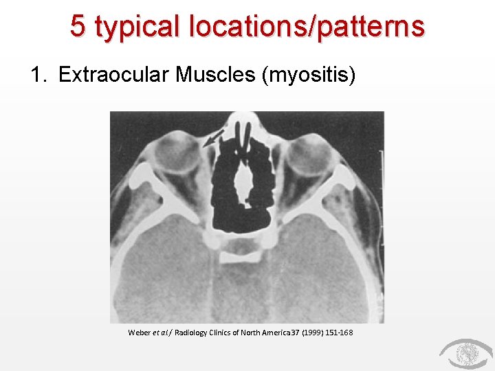 5 typical locations/patterns 1. Extraocular Muscles (myositis) Weber et al. / Radiology Clinics of