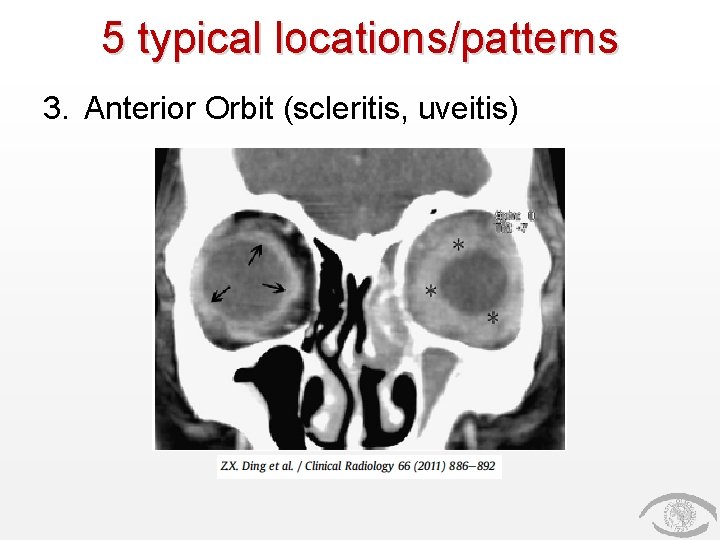 5 typical locations/patterns 3. Anterior Orbit (scleritis, uveitis) 