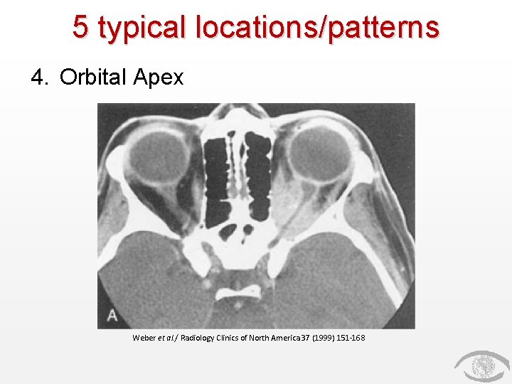 5 typical locations/patterns 4. Orbital Apex Weber et al. / Radiology Clinics of North