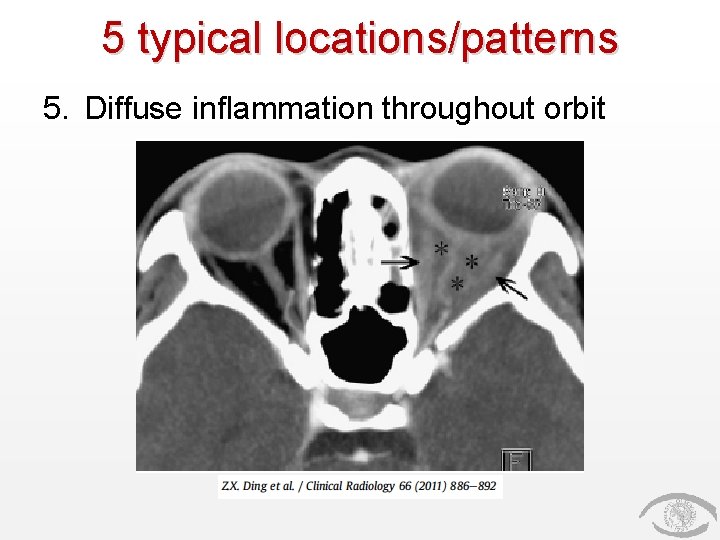5 typical locations/patterns 5. Diffuse inflammation throughout orbit 