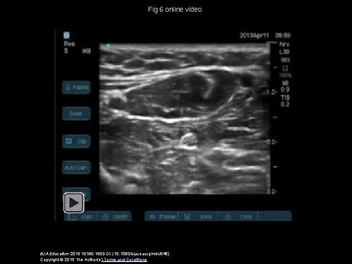 Fig 6 online video BJA Education 2015 15160 -165 DOI: (10. 1093/bjaceaccp/mku 048) Copyright