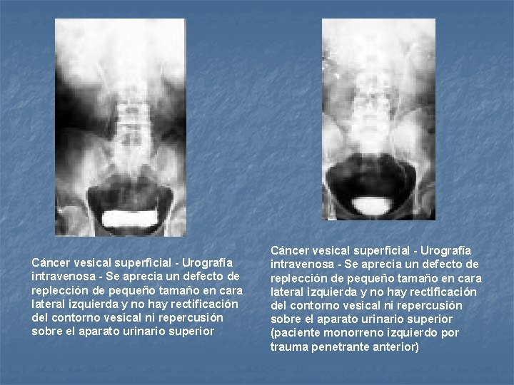 Cáncer vesical superficial - Urografía intravenosa - Se aprecia un defecto de replección de