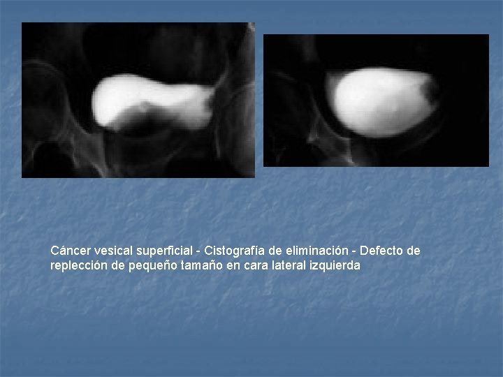 Cáncer vesical superficial - Cistografía de eliminación - Defecto de replección de pequeño tamaño