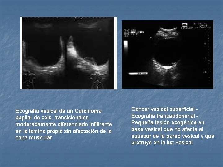 Ecografia vesical de un Carcinoma papilar de cels. transicionales moderadamente diferenciado infiltrante en la