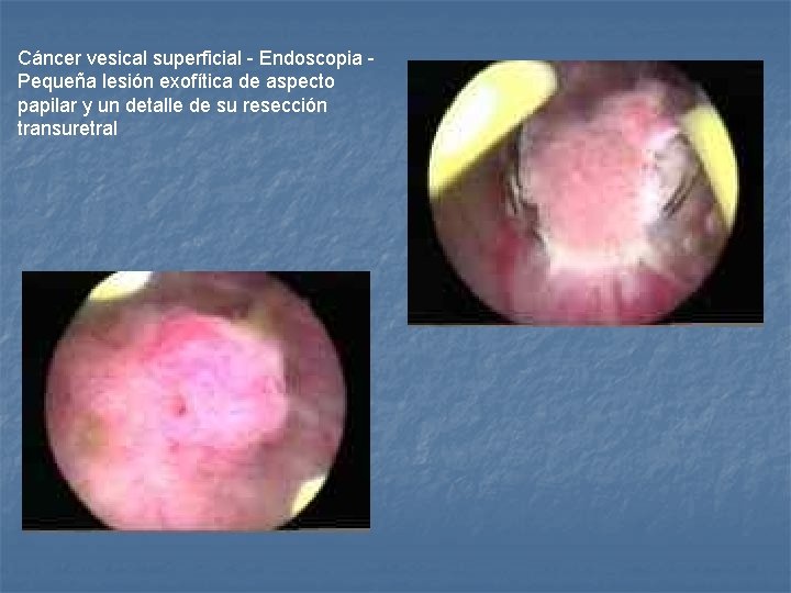 Cáncer vesical superficial - Endoscopia - Pequeña lesión exofítica de aspecto papilar y un