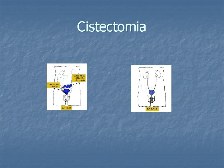 Cistectomia 