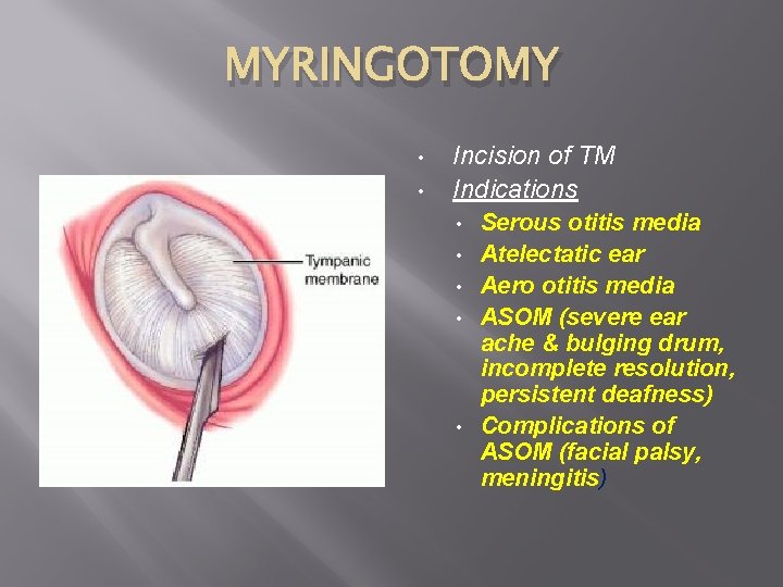 MYRINGOTOMY • • Incision of TM Indications • • • Serous otitis media Atelectatic