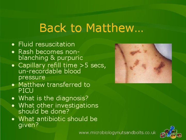 Back to Matthew… • Fluid resuscitation • Rash becomes nonblanching & purpuric • Capillary