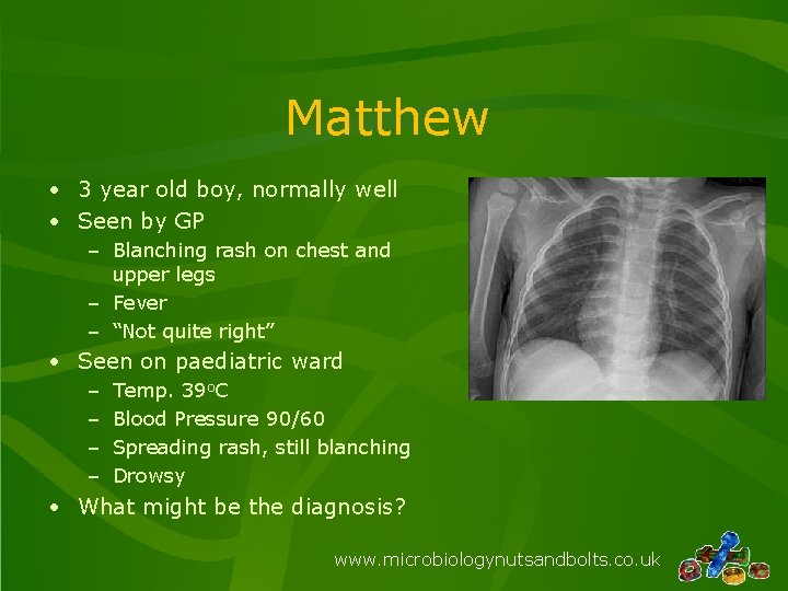 Matthew • 3 year old boy, normally well • Seen by GP – Blanching