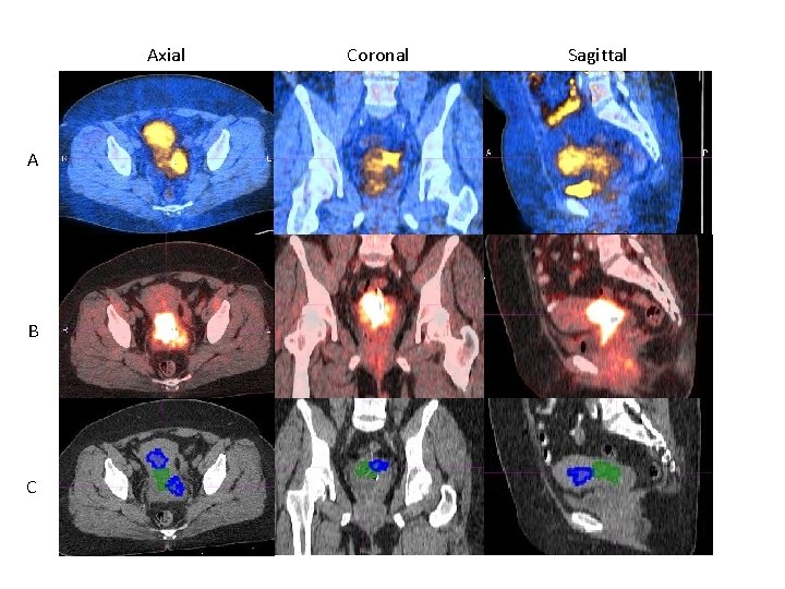 Axial A B C Coronal Sagittal 