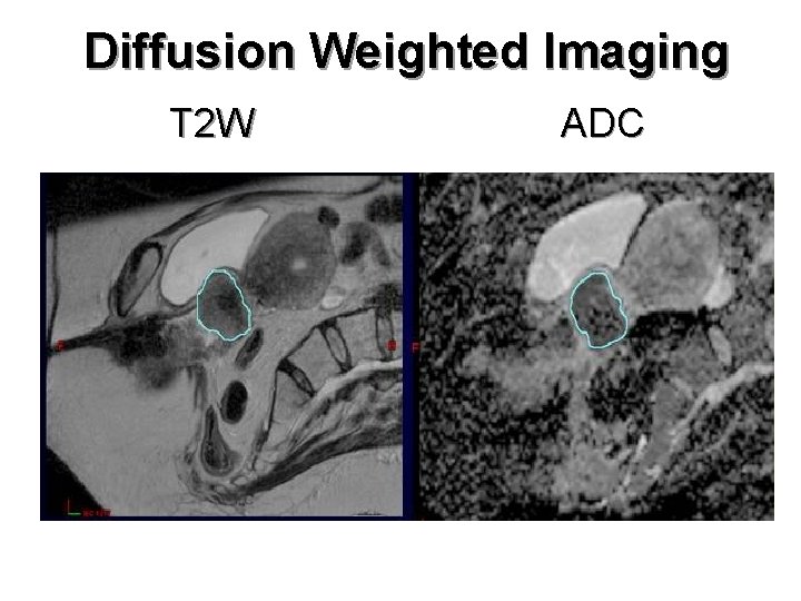 Diffusion Weighted Imaging T 2 W ADC 