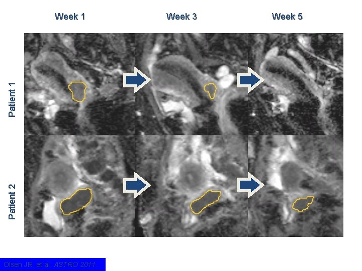 Patient 2 Patient 1 Week 1 Olsen JR, et al. ASTRO 2011. Week 3