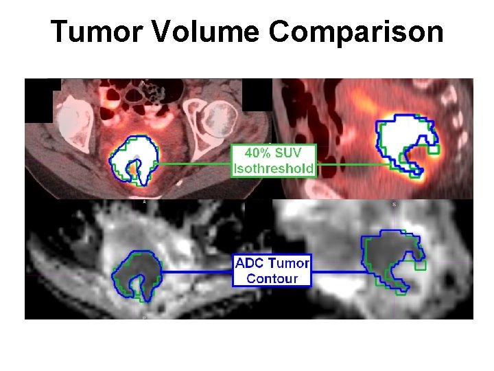 Tumor Volume Comparison 