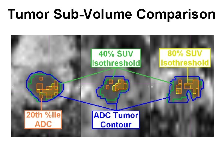 Tumor Sub-Volume Comparison 