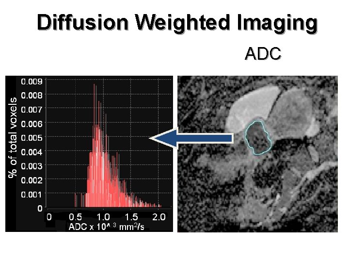 Diffusion Weighted Imaging ADC 