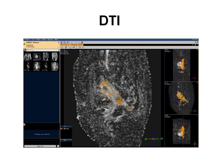 DTI 