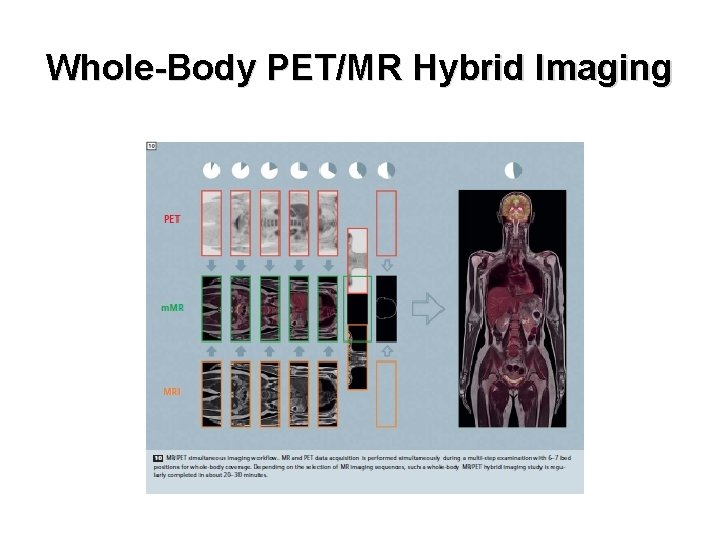 Whole-Body PET/MR Hybrid Imaging 