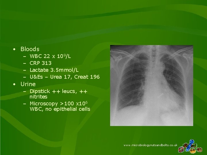 • Bloods – – WBC 22 x 109/L CRP 313 Lactate 3. 5 • Bloods – – WBC 22 x 109/L CRP 313 Lactate 3. 5