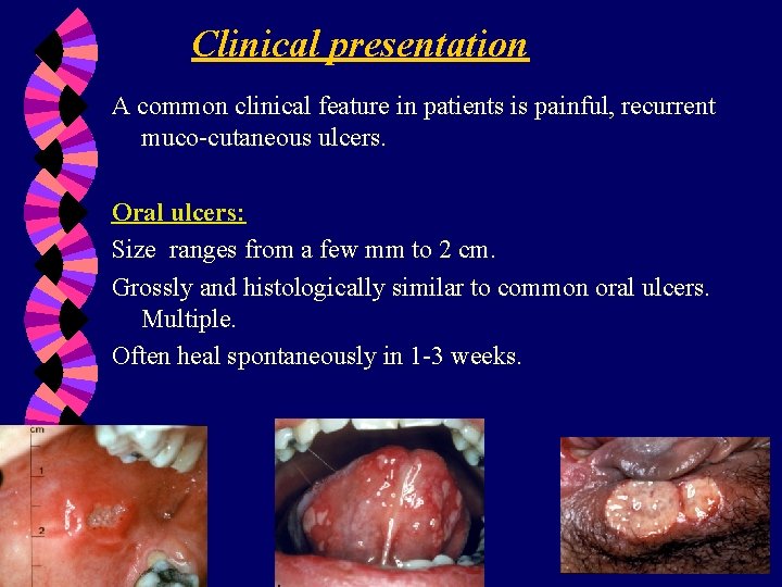 Clinical presentation A common clinical feature in patients is painful, recurrent muco-cutaneous ulcers. Oral