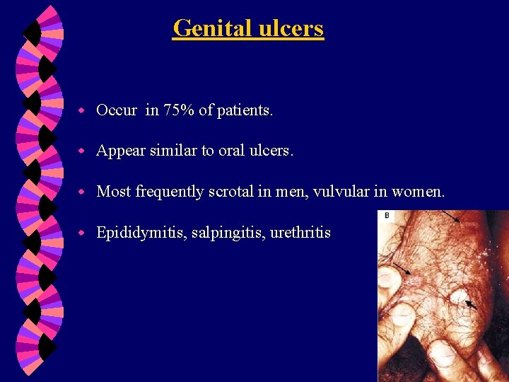 Genital ulcers w Occur in 75% of patients. w Appear similar to oral ulcers.