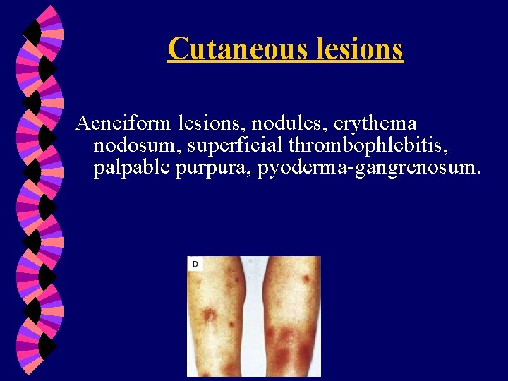 Cutaneous lesions Acneiform lesions, nodules, erythema nodosum, superficial thrombophlebitis, palpable purpura, pyoderma-gangrenosum. 