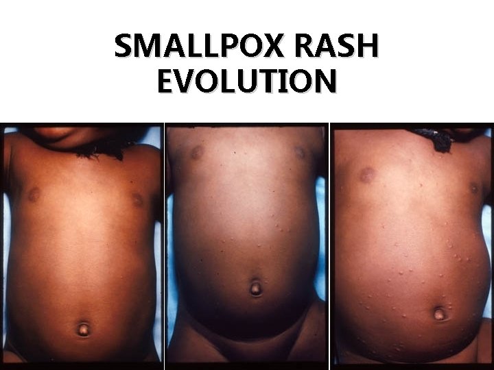 SMALLPOX RASH EVOLUTION Day 1 Day 2 Day 3 