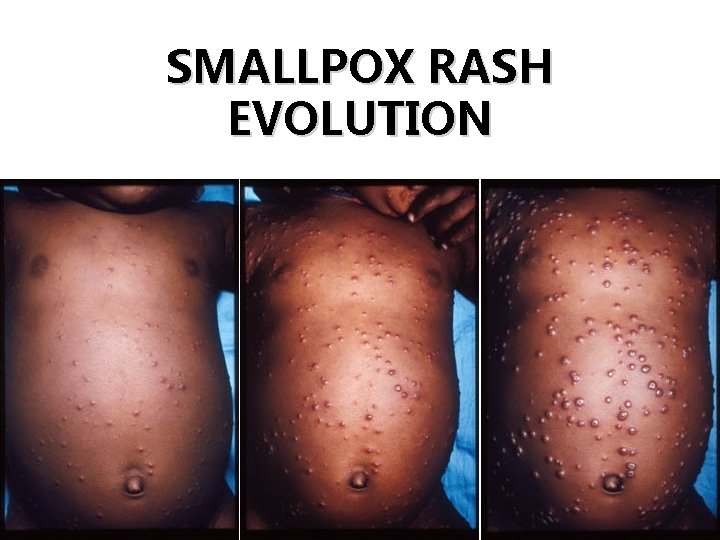 SMALLPOX RASH EVOLUTION Day 4 Day 5 Day 7 