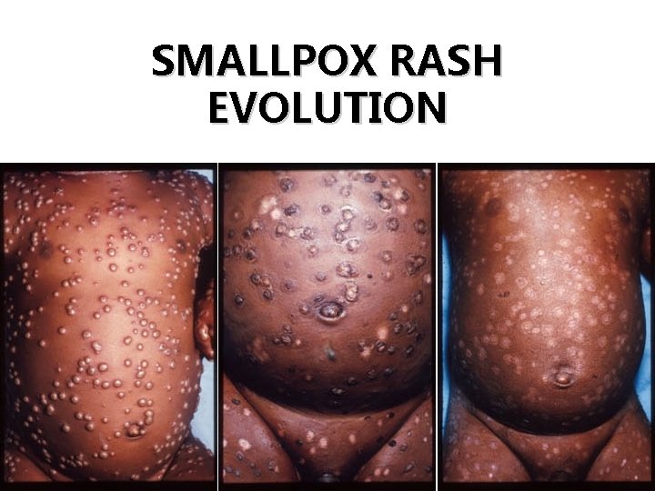 SMALLPOX RASH EVOLUTION Days 8 -9 20 Days 10 -14 Day 