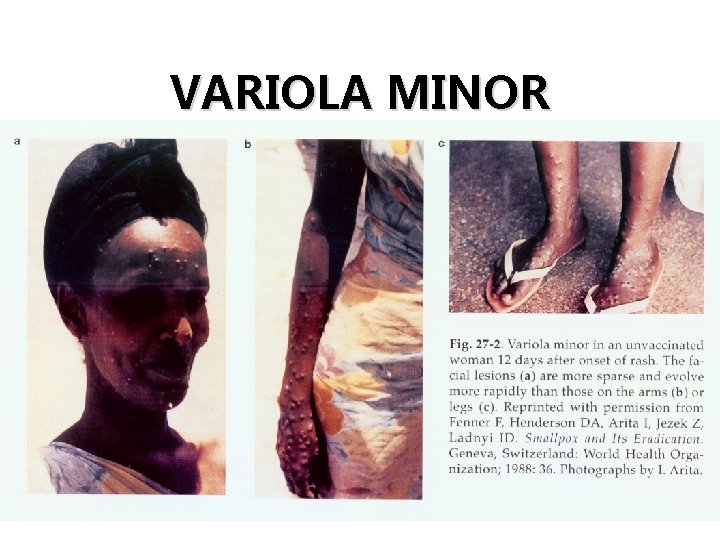 VARIOLA MINOR 