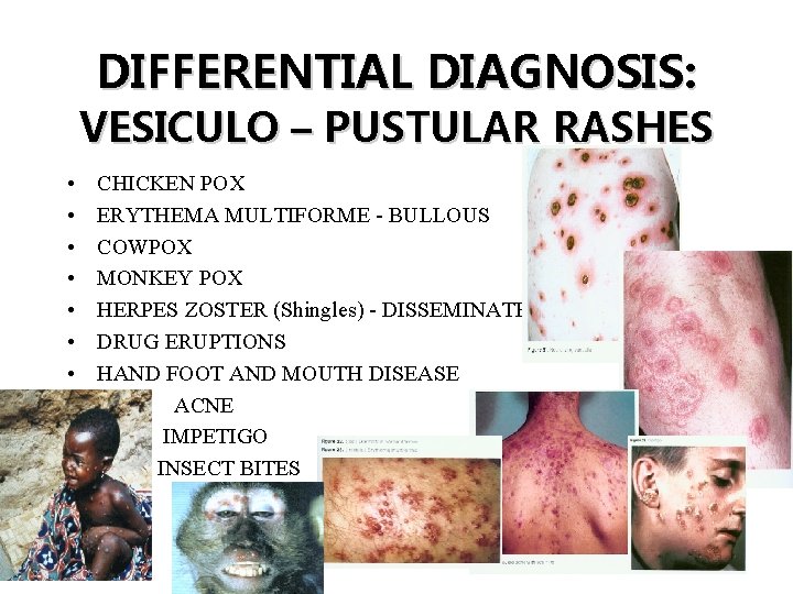 DIFFERENTIAL DIAGNOSIS: VESICULO – PUSTULAR RASHES • • • CHICKEN POX ERYTHEMA MULTIFORME -