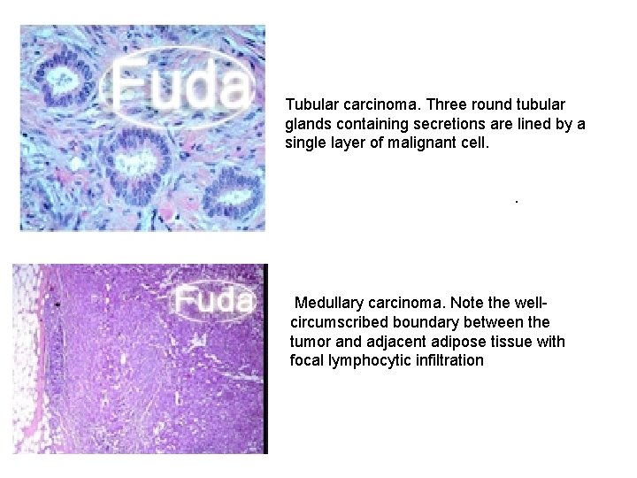 Tubular carcinoma. Three round tubular glands containing secretions are lined by a single layer