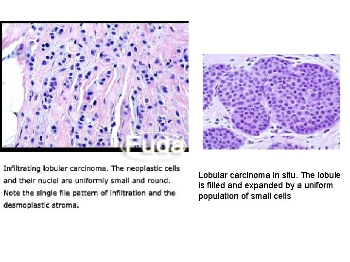 Lobular carcinoma in situ. The lobule is filled and expanded by a uniform population