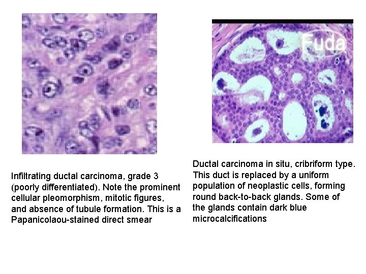 Infiltrating ductal carcinoma, grade 3 (poorly differentiated). Note the prominent cellular pleomorphism, mitotic figures,