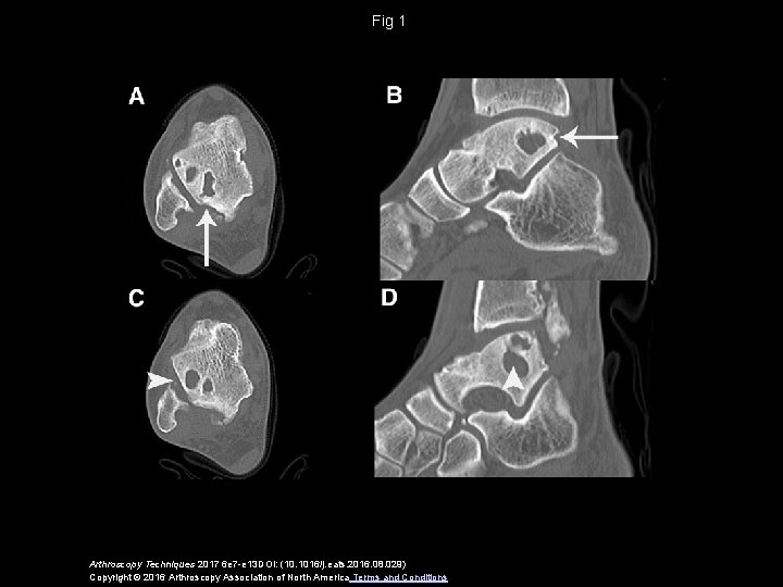 Fig 1 Arthroscopy Techniques 2017 6 e 7 -e 13 DOI: (10. 1016/j. eats.